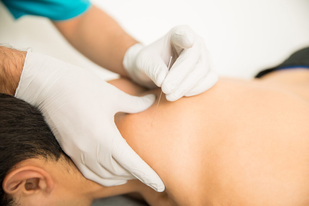 Zabieg suchego igłowania (dry needling) na plecach pacjenta w gabinecie fizjoterapii REHA-NOVA w Chomęcicach
